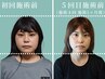 【30代・40代のしわ/たるみ対策】140本以上の美容鍼で劇的リフトアップ＆小顔