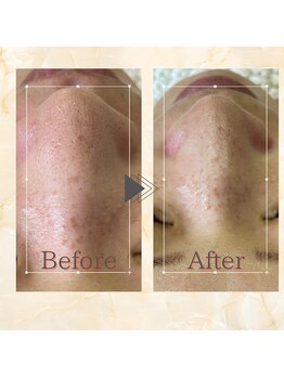 ベル(Belle)/【毛穴洗浄】小鼻の洗浄