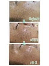 メリナ(Melina)/インナードライ肌/肌荒れ