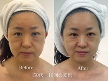 グランディールスイート(GRANDIR suite)/FACE MAKER施術結果