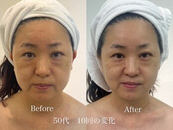 グランディールスイート(GRANDIR suite)/FACE MAKER施術結果