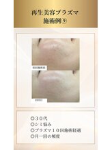 イデアーレ(ideale)/３０代・プラズマシミケア