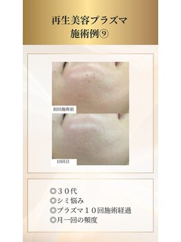 イデアーレ(ideale)/３０代・プラズマシミケア