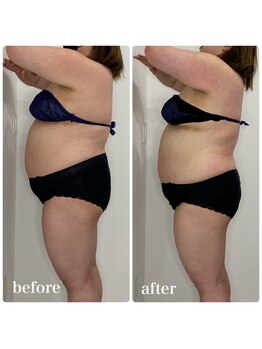 カプリス(CAPRiCE)/リンパドレナージュ