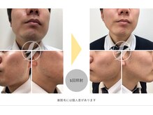 イー(iii)/ヒゲ脱毛効果