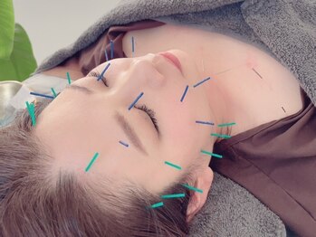 鍼グリッター 岡山本院(鍼Glitter.)/リフトアップと小顔に特化美容鍼