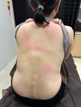 スパチャーレ(Spa ciare)/トーンヌール貼布後