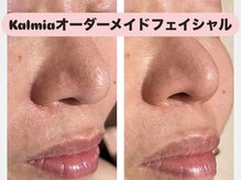 カルミア(kalmia)