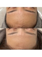 ヴェルシック(Belchic)/瞼の色素の沈着も改善可能