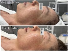 エミマス ボーテ(Emimas Beaute’)/６０代　毛穴洗浄＆幹細胞