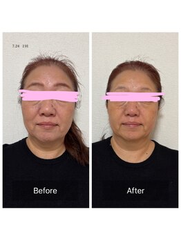 マハロ 海老名店(Mahalo)/小顔矯正４０代