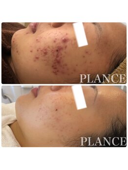 リアム(Liam)/ニキビプログラム始まりました!