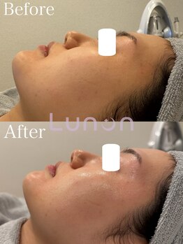 ルノン(Lunon)/毛穴洗浄ハイドロ×ララピール