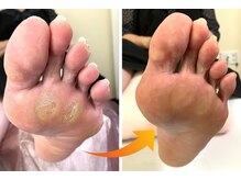 ハラリエ(Hararie)/硬くなったたこを今こそ除去！