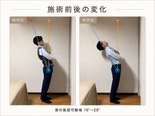 テラス 千葉(TERAS)/腰痛・姿勢改善で来店/20代男性