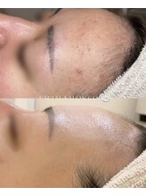 【毛穴洗浄付・ニキビケア＆肌荒れ改善コース】13回後・拡大してご覧ください