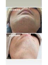 リンカ(Rinca)/ヒゲ脱毛　初めて→1ヶ月後