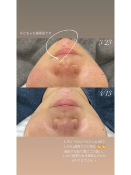 ラ クレール ビューティーサロン(LA CLAIR)/レチノールピール