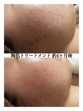 ルタンリッシュ さいたま店(Lutan Riche)/繰り返すニキビケア