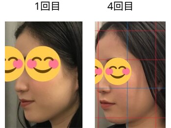 ベル/20代の方の小顔Before After