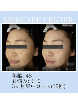 アンジェラックス スキンケアセンター 渋谷/シミ・色むら改善