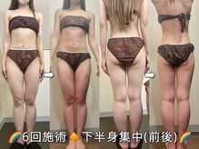 サロンドココ(Salon de COCO)/ハイパーナイフ/下半身痩身/美脚