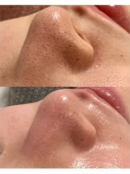 サロンドレヴ(salon de LaEv)/毛穴