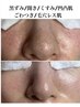 【毛穴黒ずみ/開きのお悩みに毛穴レス肌メニュー】毛穴エクストラクションpro