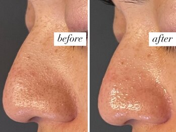 ベルーテ 田町三田(Bellute)/メンズも毛穴管理!