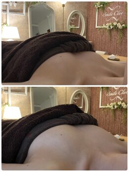 スマイルクルー(SmileClue)/初回ビフォーアフター症例