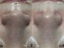 ナチュールムーン(Nature moon.)/毛穴洗浄