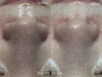 ナチュールムーン(Nature moon.)/毛穴洗浄