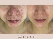 リノン(LINON)