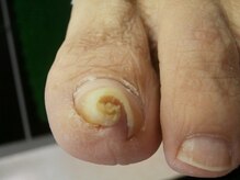 爪切り屋 足楽 日本橋三越前店/こんなお爪の方も。