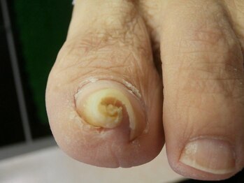 爪切り屋 足楽 日本橋三越前店/こんなお爪の方も。