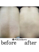 ビーエスアクアビューティー/背中ケア