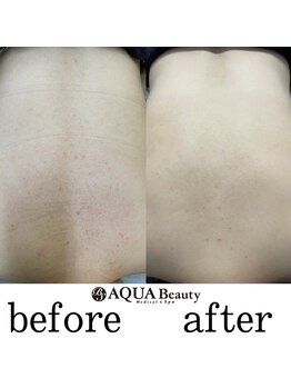 ビーエスアクアビューティー/背中ケア