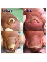 巻き爪補正店 大阪京橋店/【大阪・京橋】【強い】巻き爪