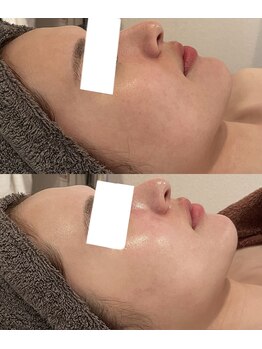 ミベル(MeBell)/小顔コルギ+セラピール施術直後