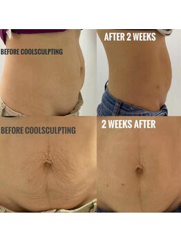 クライオ360(Cryo360)/脂肪冷却ビフォーアフター