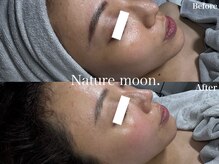 ナチュールムーン(Nature moon.)/ハーブピーリング