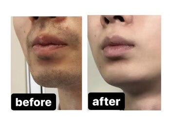 メンズ脱毛ジャパン 南小倉駅前店(メンズ脱毛JAPAN)/【Before＆After】ヒゲ脱毛