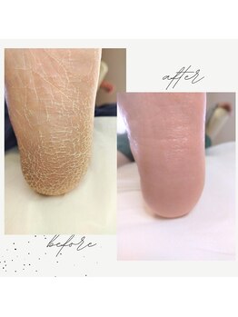 リゼラアンドコー 鹿沼店/ガサガサかかとの角質ケア(*^^*)