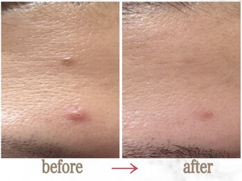 ナチュラーレ 京都四条烏丸店(Naturale)/美肌ニキビケア小顔フェイシャル