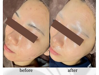 アン ビューティー(ann beauty)/リピーター様 20代女性