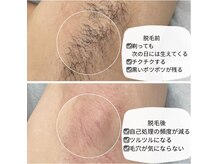 サロンドベルム(Salon de BELME)の雰囲気（減毛効果抜群◎シュガーリング×光脱毛を組み合わせたW脱毛）