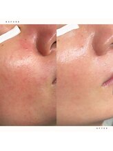 イチロクイチハチ(1618)/赤ら顔の改善に