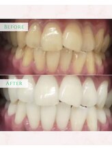 シカホワイトニングトウキョウ 笹塚店(CICA Whitening Tokyo)/ビフォーアフター（20代女性）