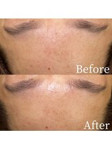 ユカリス(Yu.charis)/ハーブピーリング before/after