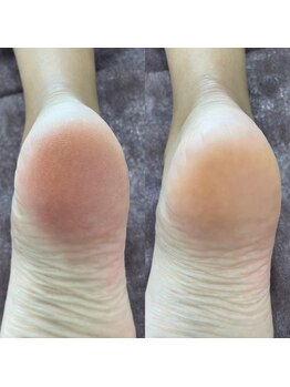 ウルル(ULuLu)/1回で古い角質カサカサ改善!